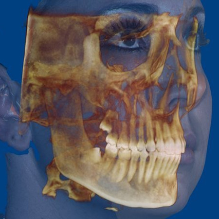 3D CBCT imaging scan showing a semi-transparent render of human facial bone structure and teeth.