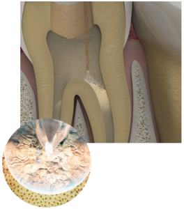 Medical illustration of a tooth cross-section showing laser endodontic treatment inside root canals.